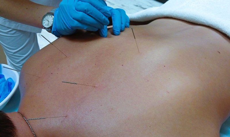 Теперь не только консультация: запись на сеансы иглоукалывания к неврологу