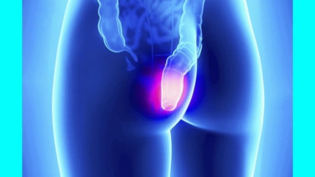 Лечение хронического геморроя